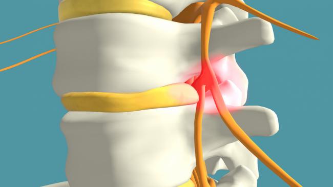 Five Ways to Tell if Your Back Pain Is Due to Facet Joint Inflammation